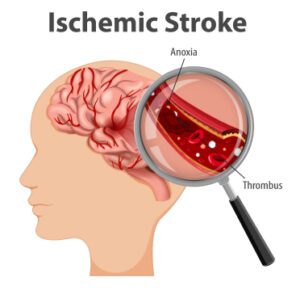 Ischaemic stroke