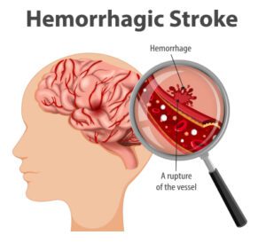 Haemorrhagic stroke