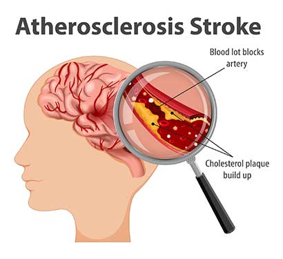 Transient Ischaemic Attack